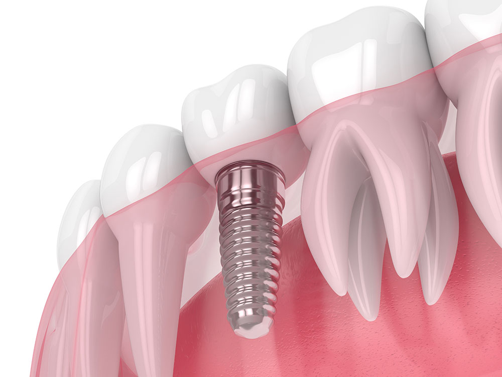 dental implants glasgow