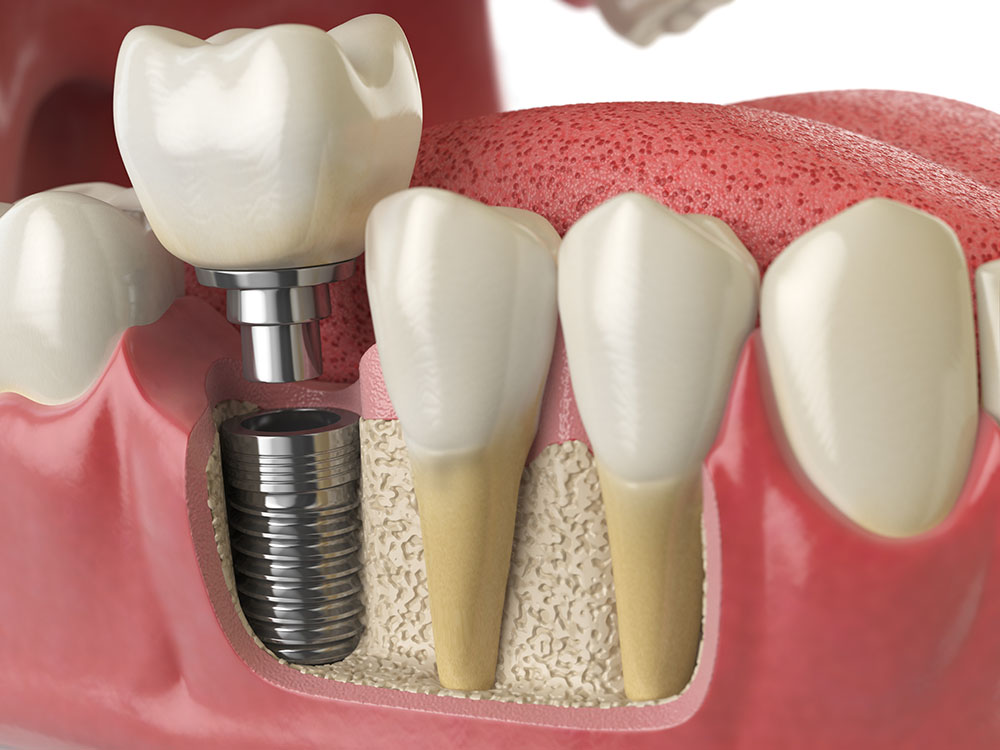 teeth dental implants glasgow