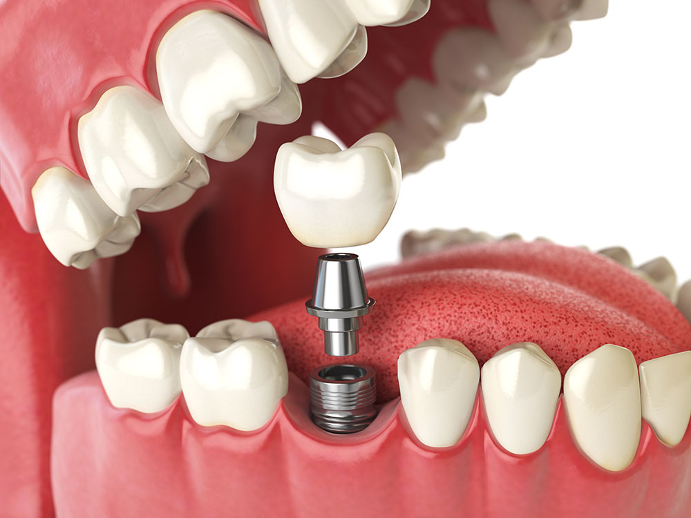 teeth with dental implants glasgow